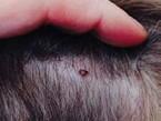 tick bite on scalp hidden by hair