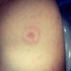 tick bullseye rash