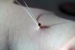tick being removed with tick tool